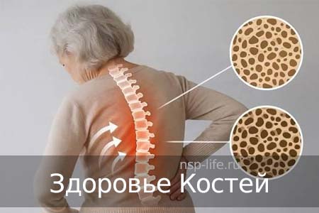Остеопороз. Перелом костей. Как укрепить кости. Где купить БАД НСП для костей в Москве, Санкт-Петербурге официально. Цена. Отзывы. Сайт NSP. Интернет-магазин